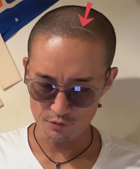 松岡昌宏の頭部の傷跡